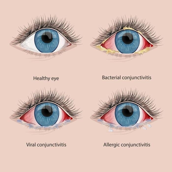 types of pink eye