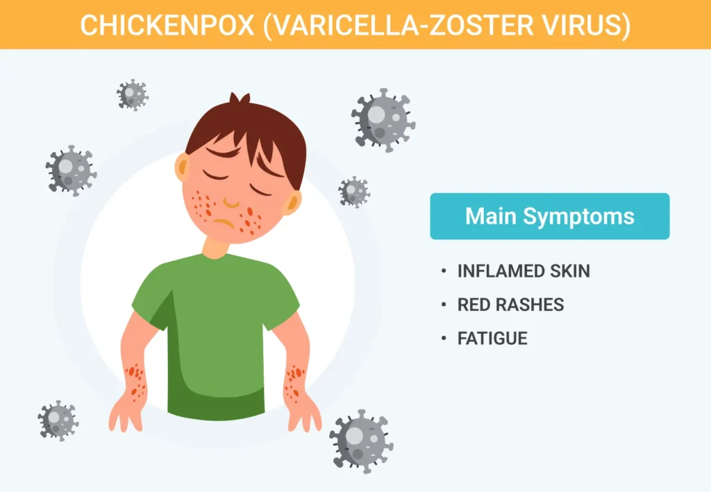 Chickenpox-Varicella-Zoster-Virus
