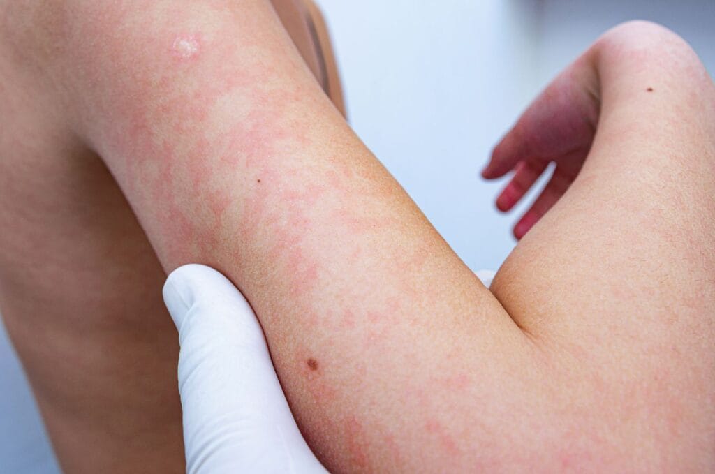 Effective Heat Rash Treatment and Prevention - All Day Medical Care Clinic