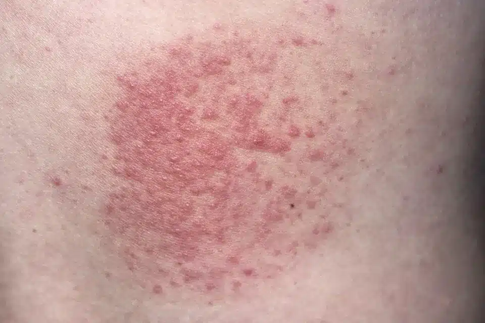 What Causes a Heat Rash